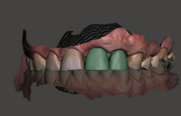 Digitally designed zirconia bridge using the smallest multi-unit and small sleeve