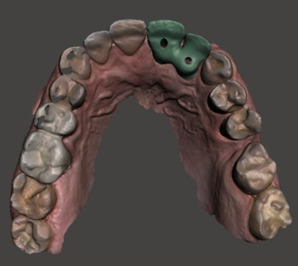 Digitally designed zirconia bridge using the smallest multi-unit and small sleeve