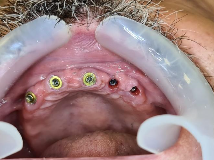 Implants with already installed MUA V-type on which the bar for a removable denture will be attached