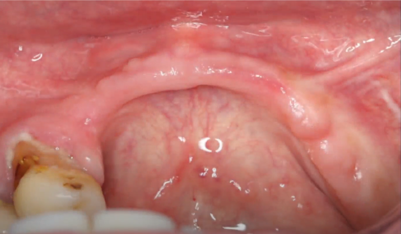 Initial state of the edentulous area of ​​the jaw (upper image) and the first longitudinal incision for access to the alveolar ridge YouTube / Dr. Kamil Khabiev / Dental Guru Academy