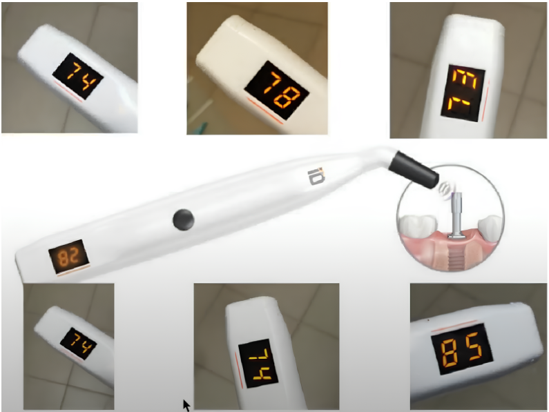 Instrument readings to determine the primary stability of placed implants: all implants are placed with very good indicators, which allow immediate loading of the implants YouTube / Dr. Kamil Khabiev / Dental Guru Academy