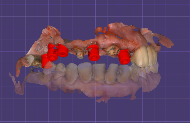 Intraoral scan results