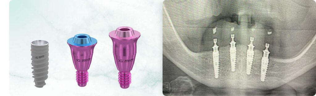 Total Mandibular Bar Restoration: Screw Retention Using MUA V-Type with Ultra Low Profile