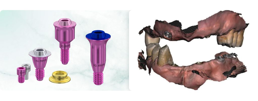 Advantages of Ultra-Compact MUA V-Type Solutions: Clinical Examples