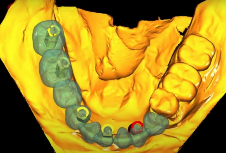 Modeling the optimal locations of implants and the prosthesis that will rest on these implants YouTube / Dr. Kamil Khabiev / Dental Guru Academy