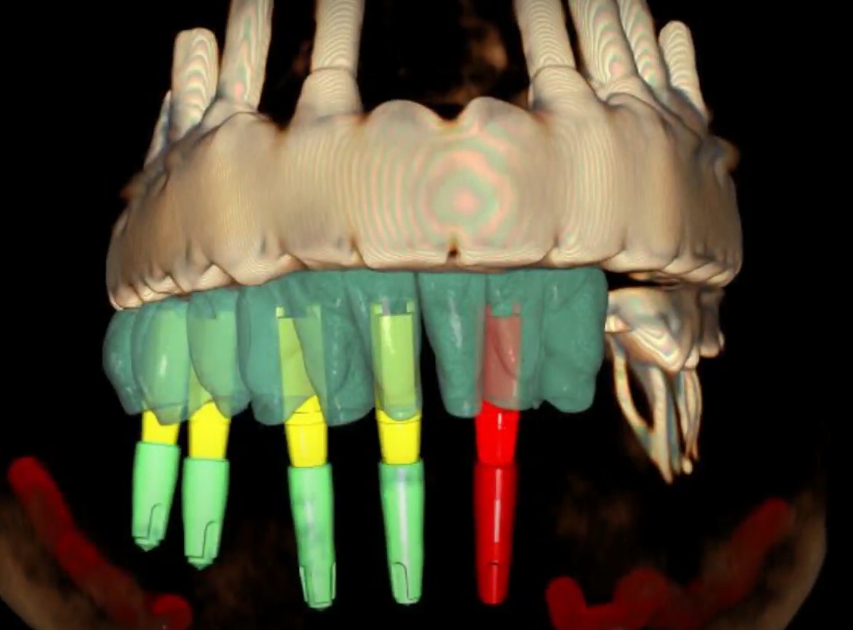 Overlay image of implants with virtual scan markers and prosthesis YouTube / Dr. Kamil Khabiev / Dental Guru Academy