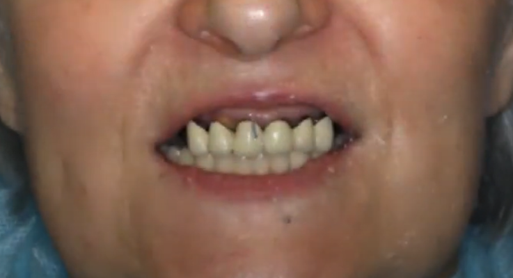 Patient with a failing RPD: poor appearance and compromised function YouTube / Dr. Kamil Khabiev / Dental Guru Academy
