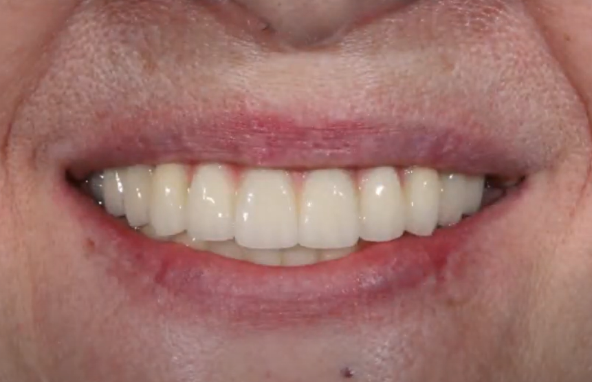 Permanent restoration with excellent aesthetic results YouTube / Dr. Kamil Khabiev / Dental Guru Academy