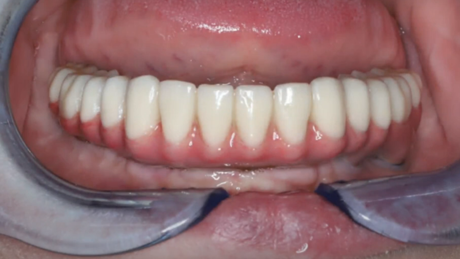 Permanent upper jaw prosthesis base - cobalt-chrome frame, composite facing YouTube / Dr. Kamil Khabiev / Dental Guru Academy