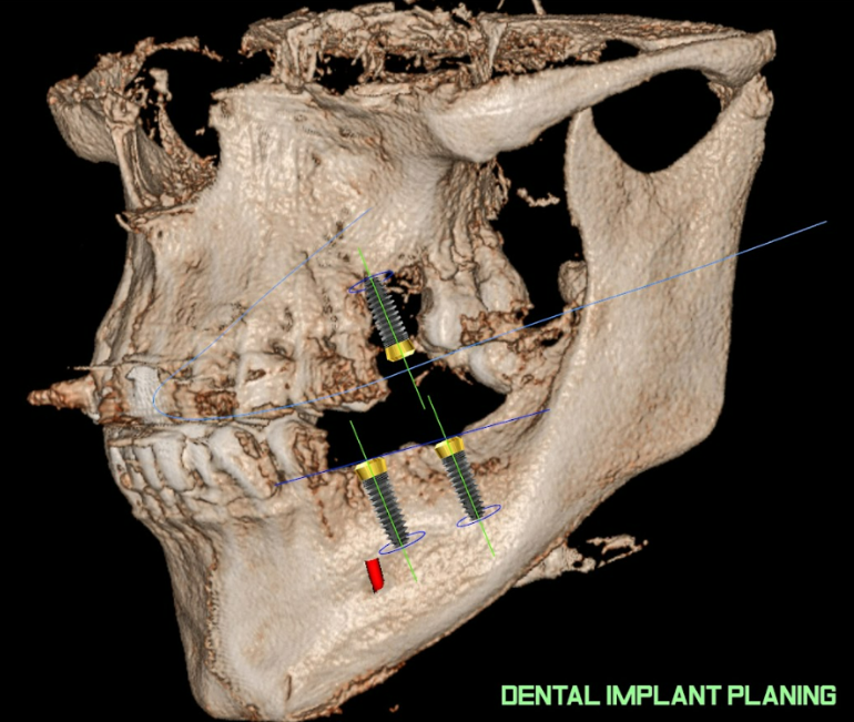 Planning the location of the implants on a digital 3D model of the jaws (image from Shutterstock)