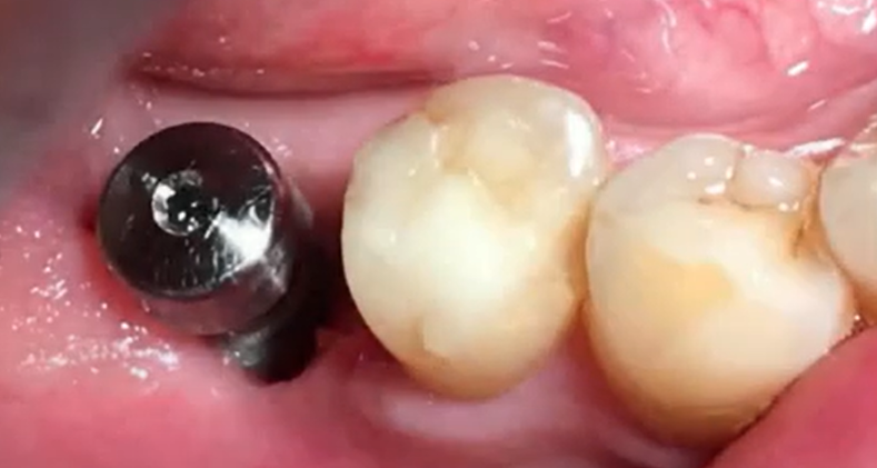 Poorly formed soft tissue attachment around the healing cap YouTube / Dr. Kamil Khabiev / Dental Guru Academy