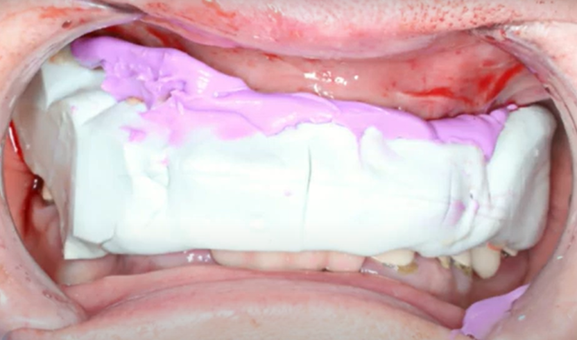Postoperative maxillary relief recording for the laboratory YouTube / Dr. Kamil Khabiev / Dental Guru Academy