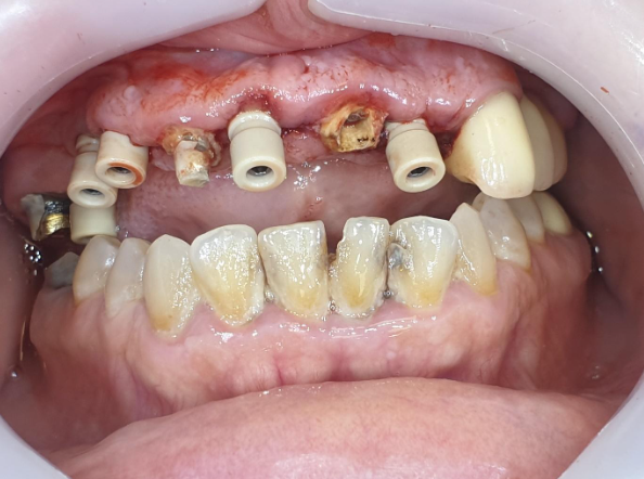 Preparing for scanning with an intraoral scanner