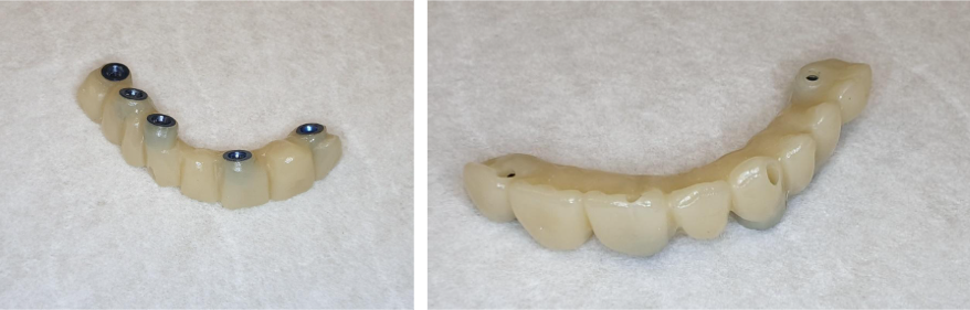Screw-retained prosthesis on V-type multi-units