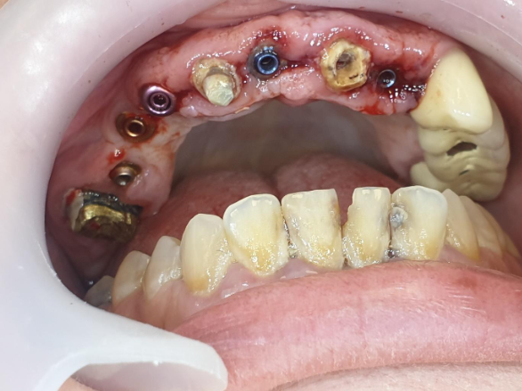 Soft tissue condition after removal of the first temporary bridge
