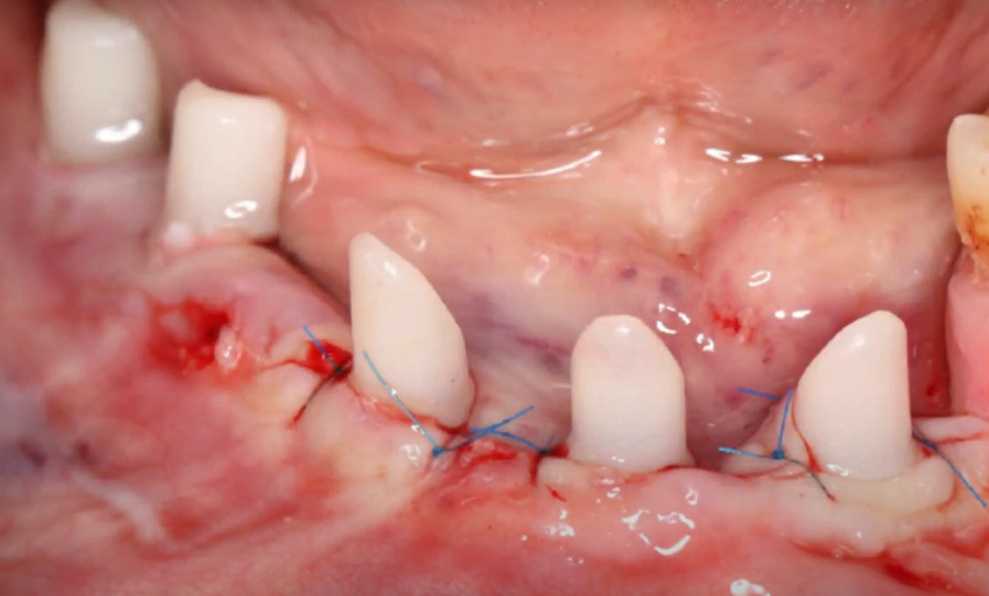 Temporary abutments and sutured soft tissues immediately after implant placement YouTube / Dr. Kamil Khabiev / Dental Guru Academy