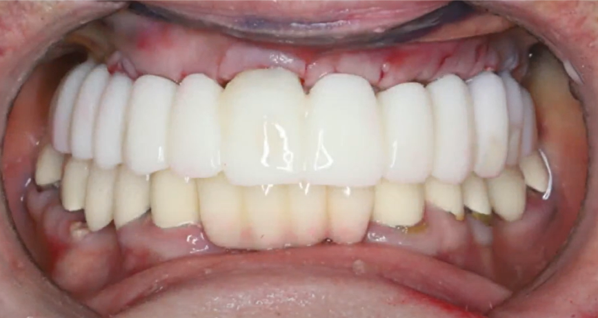 Temporary restoration in place for healing and osseointegration YouTube / Dr. Kamil Khabiev / Dental Guru Academy