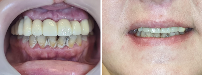 The appearance of the screw-retained prosthesis is encouraging