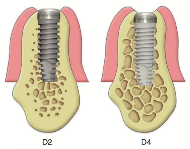 The difference in implant contact area in varying bone densities (in D2 bone, the contact area of ​​titanium with bone is much larger) YouTube / Dr. Kamil Khabiev / Dental Guru Academy