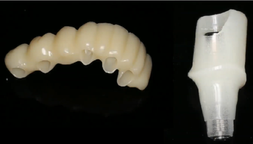 The temporary abutment and restoration are made and are kept by the doctor before the operation YouTube / Dr. Kamil Khabiev / Dental Guru Academy