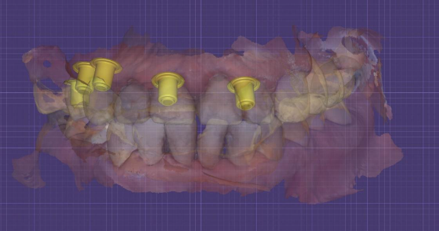 Visualization of the location of the bushings fixing the prosthesis