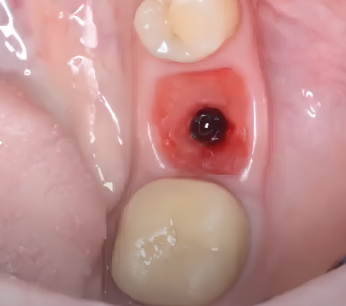 Well-formed gingiva prepared for restoration YouTube / Dr. Kamil Khabiev / Dental Guru Academy