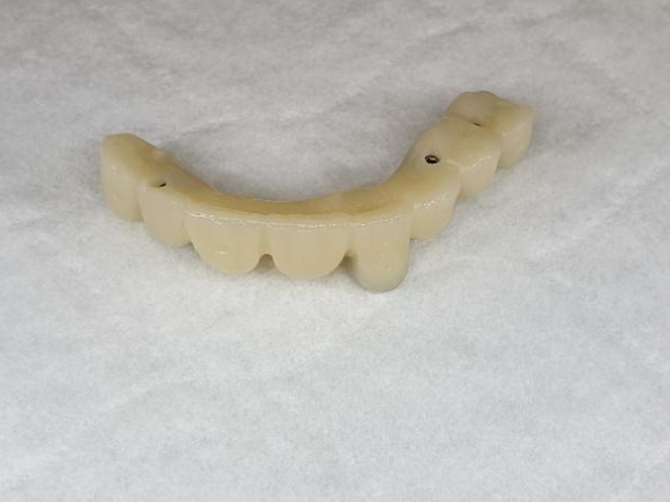 Zirconium dioxide upper jaw bridge