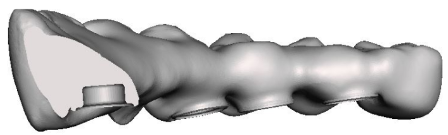 Model of a new bridge with increased thickness due to the elimination of the screw channel and reduction of the bushing height