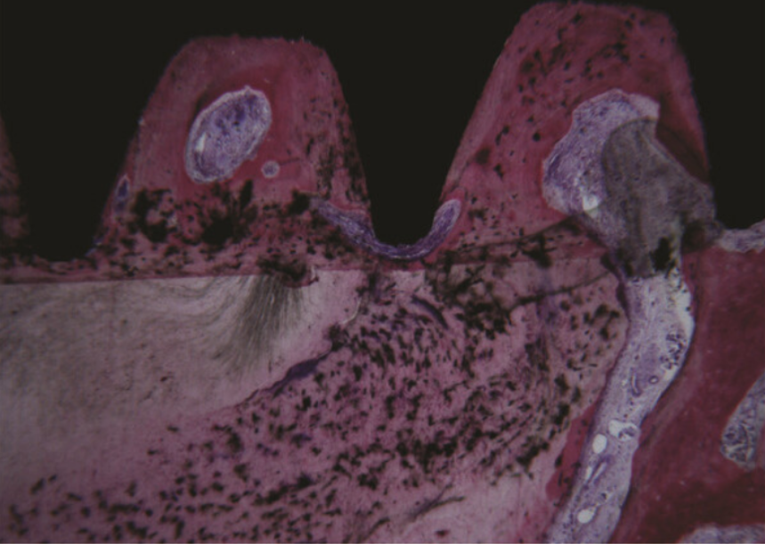 In the apical portion of the root, it was observed that the cementum migrated from the residual root to the implant surface. Acid fuchsin-toluidine blue 40x. YouTube / Dr. Kamil Khabiev / Dental Guru Academy