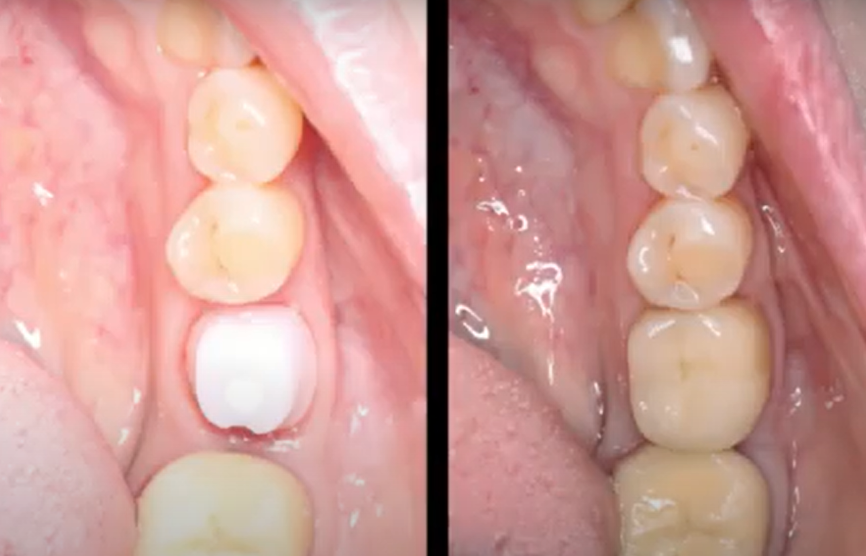 Final stage: custom abutment for cement-retained restoration (left) and definitive crown (right) YouTube / Dr. Kamil Khabiev / Dental Guru Academy