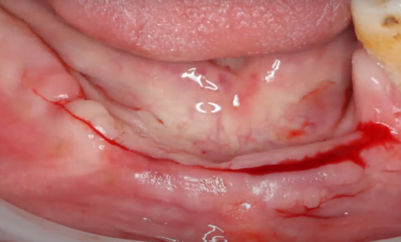 Initial state of the edentulous area of ​​the jaw (upper image) and the first longitudinal incision for access to the alveolar ridge YouTube / Dr. Kamil Khabiev / Dental Guru Academy