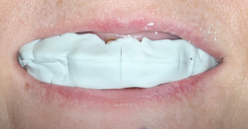 Making a cast to register the position of the jaws and the position of the dental arches YouTube / Dr. Kamil Khabiev / Dental Guru Academy