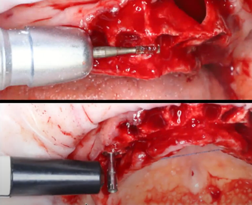 The process of bone ridge reduction with immediate implant placement, in the lower image the primary stability of the implant is checked by compact resonance frequency analysis (RFA) device YouTube / Dr. Kamil Khabiev / Dental Guru Academy