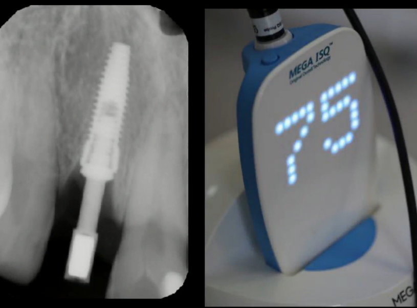 Mega-ISQ readings during primary implant stability assessment YouTube / Dr. Kamil Khabiev / Dental Guru Academy