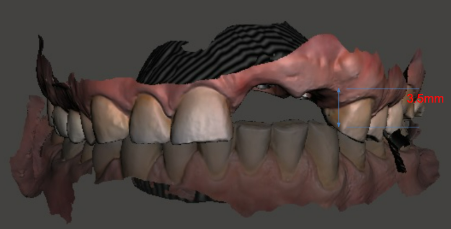 3D image in lateral projection, where the small distance between the lower tooth and the gingiva of the upper jaw is visible