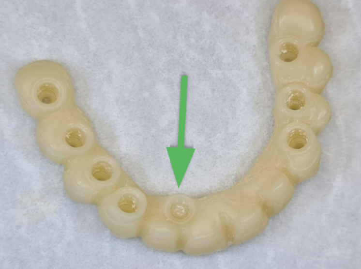 New temporary bridge without screw channel in the area of ​​the second incisor