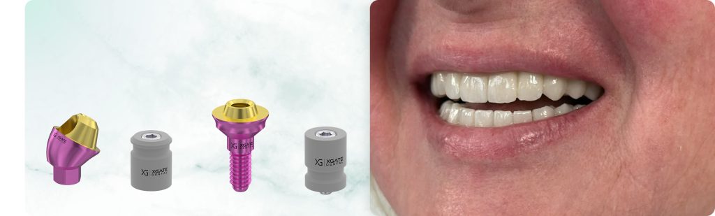 Full-Arch Restoration of Maxillary and Mandibular Arches with Mandibular Tooth Extraction: Screw-Retention on V-type and D-type Multi-Unit Abutments by XGate Dental