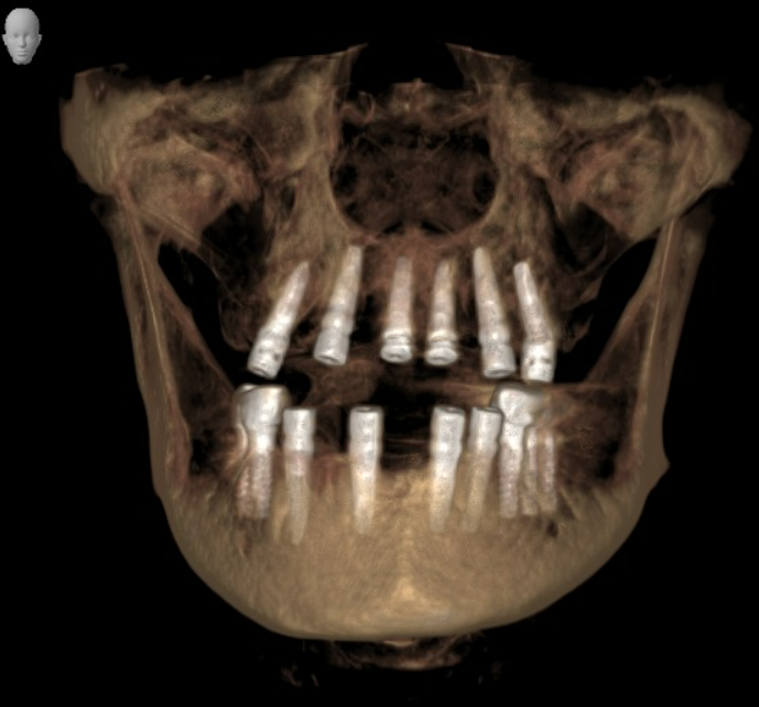 3D rendering of a jaw with planned positions for multiple dental implants, part of surgical guide manufacturing.