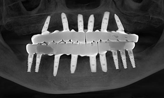 Final panoramic X-ray showing two full-arch bridges permanently seated on dental implants in the maxillary and mandibular arches