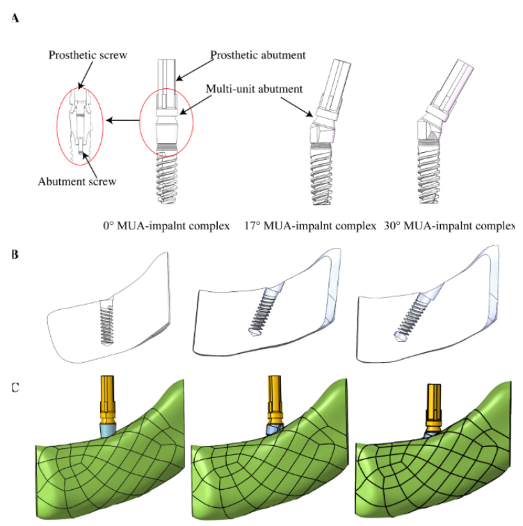 The MUA implant complex models with different angulations (0°, 17°, and 30°). A, 3D model and detailed components of MUA - implant complex with different angulations. B, The section profile of implant-bone models with different implant angulations. C, The meshed models of the MUA-implant complex and bone. Research Square/ rs-4446322/v1/ Dong Lin/ Jun 2024