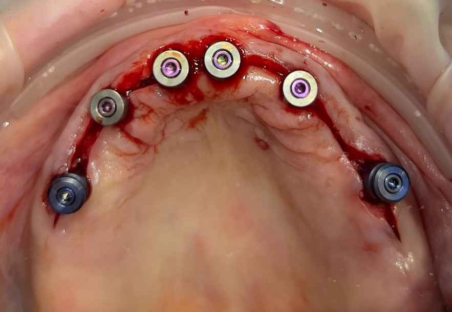 Clinical photograph of the mandible showing new abutments and scan bodies placed on existing dental implants after the removal of previous bridges