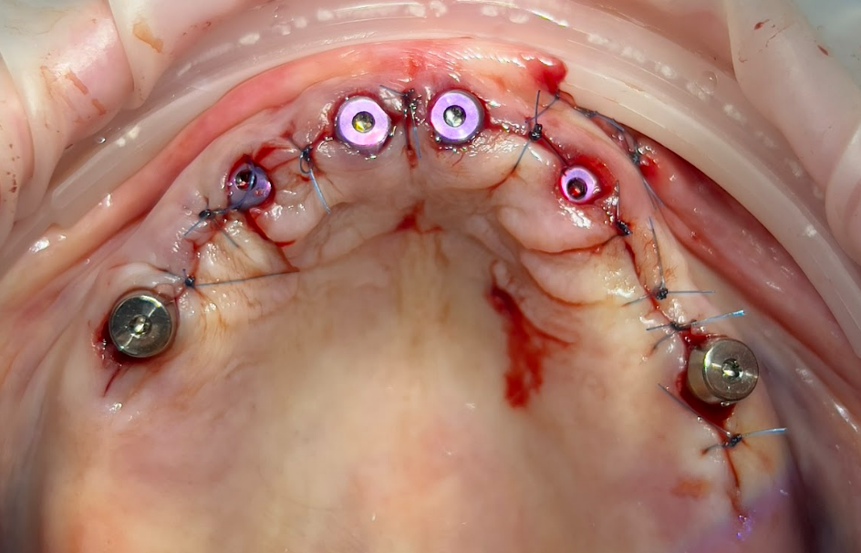 Immediate post-operative view of the maxillary arch showing newly placed dental implants protected by healing caps with sutures in the soft tissue