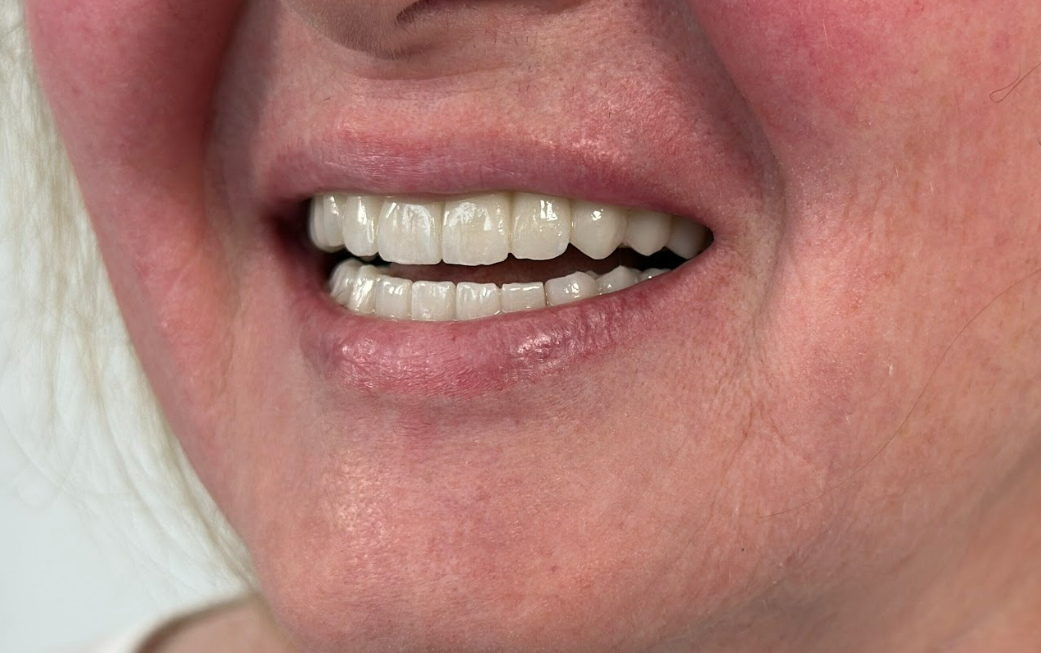 A close-up photograph of a patient's happy and healthy smile, showcasing the final aesthetic result of a full-mouth dental restoration