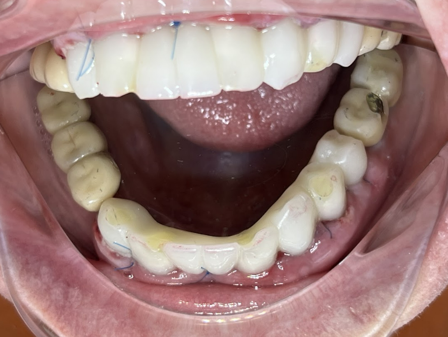 The final result of a full-mouth rehabilitation, showing the patient's smile with permanent zirconia dioxide restorations on both the maxillary and mandibular arches
