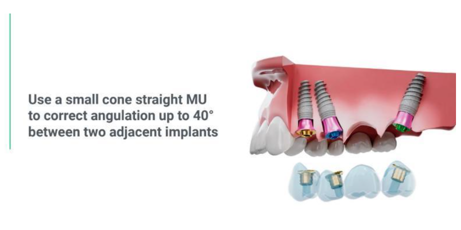 The principle of using straight multi-unit V-type abutments with angulated implants