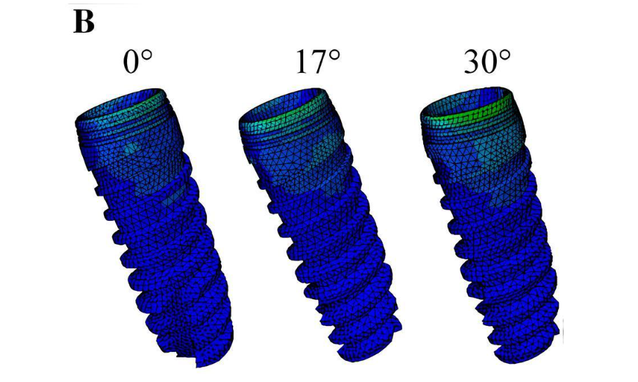 The stress distribution of the implant of the MUA-implant complex with different abutment angulation (0°, 17° and 30°). A, The stress distribution of implants under loading condition A, B. The stress distribution of implants under loading condition B.C, The stress distribution of implants under loading condition C. Research Square/ rs-4446322/v1/ Dong Lin/ Jun 2024