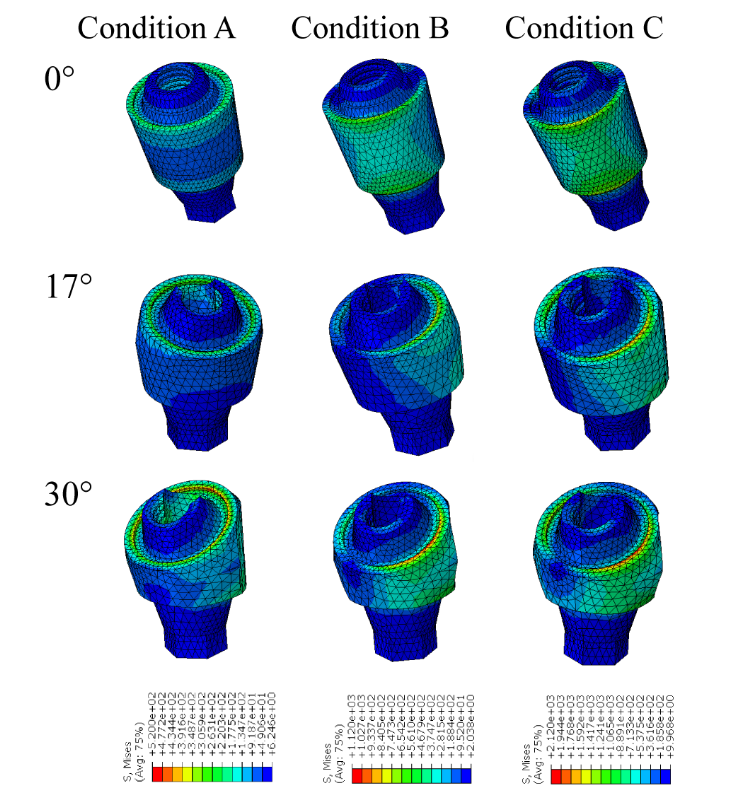 The stress distribution of the MUA with varies abutment angulation under loading condition A, condition B and condiction C. Research Square/ rs-4446322/v1/ Dong Lin/ Jun 2024