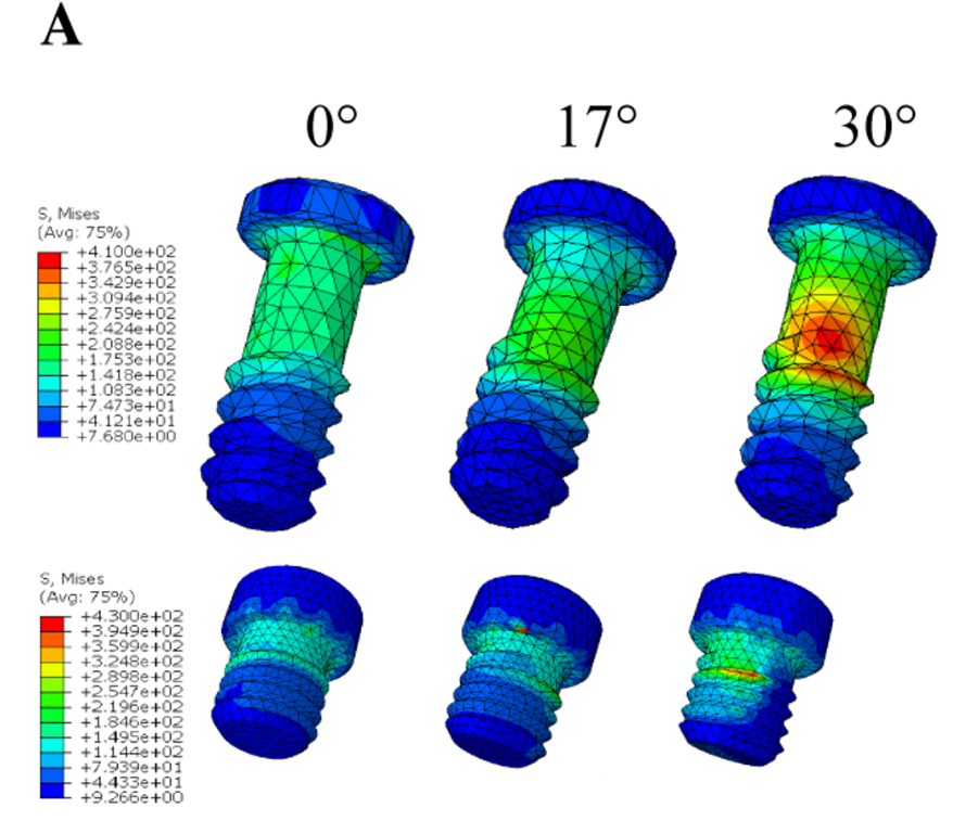 The stress distribution of the screws (abutment screw and prosthetic screw). A, The stress distribution of screws under loading condition A. B, The stress distribution of screws under loading condition B. C, The stress distribution of screws under loading condition C. Research Square/ rs-4446322/v1/ Dong Lin/ Jun 2024