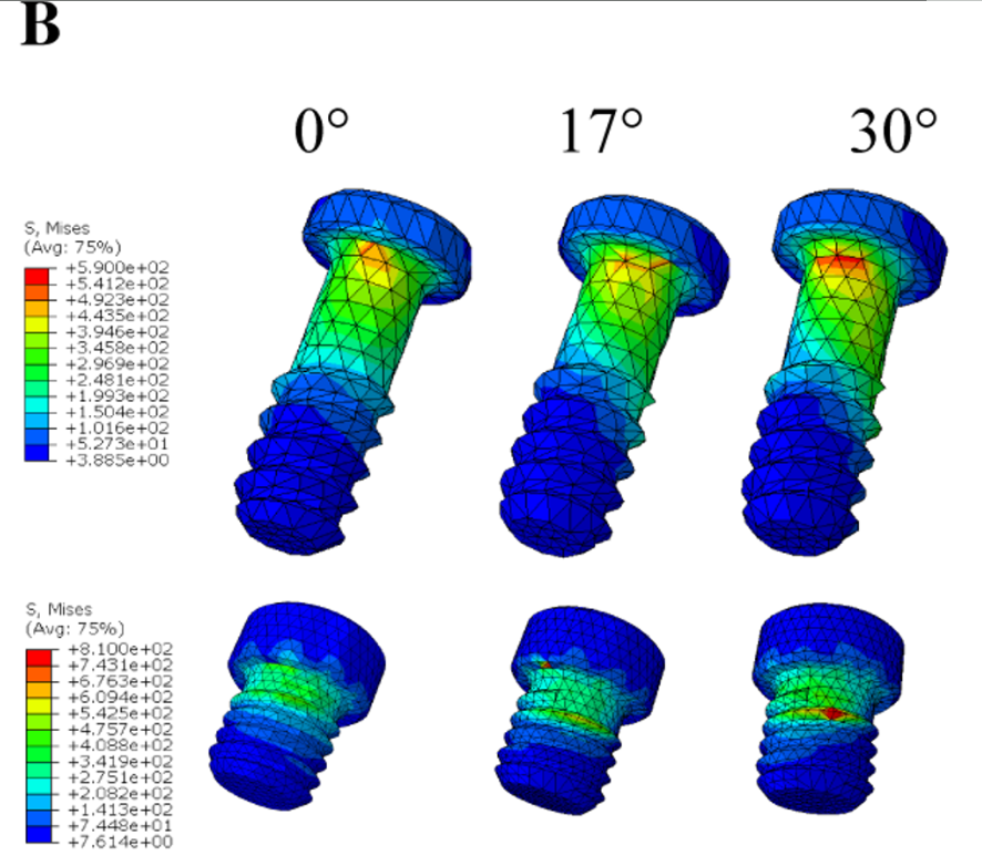 The stress distribution of the screws (abutment screw and prosthetic screw). A, The stress distribution of screws under loading condition A. B, The stress distribution of screws under loading condition B. C, The stress distribution of screws under loading condition C. Research Square/ rs-4446322/v1/ Dong Lin/ Jun 2024