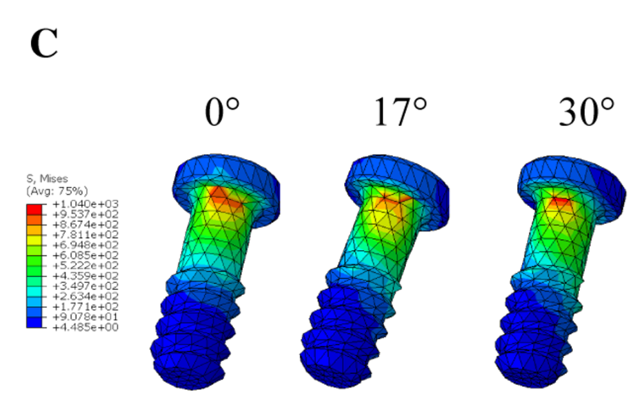 The stress distribution of the screws (abutment screw and prosthetic screw). A, The stress distribution of screws under loading condition A. B, The stress distribution of screws under loading condition B. C, The stress distribution of screws under loading condition C. Research Square/ rs-4446322/v1/ Dong Lin/ Jun 2024